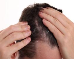 Dandruff Scalp Soothing Shot