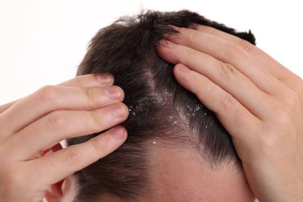 Dandruff Scalp Soothing Shot